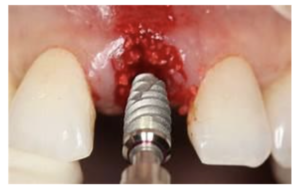 Cost of Dental Implants